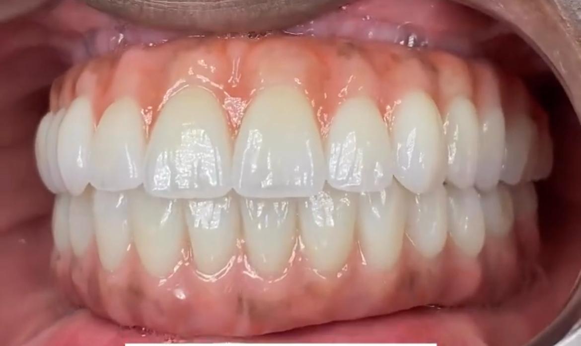 Resultado final in-mouth